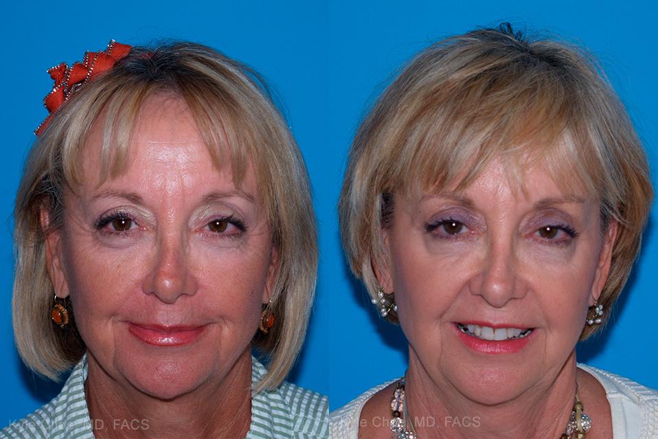  before and after photos in , , Laser Skin Resurfacing in Virginia Beach, VA