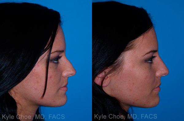  before and after photos in , , Non-Surgical Rhinoplasty in Virginia Beach, VA
