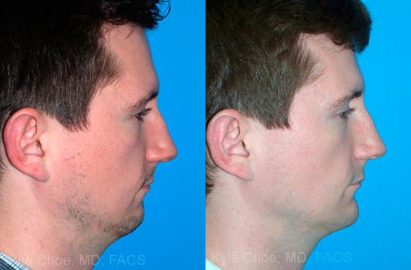  before and after photos in , , Chin Augmentation in Virginia Beach, VA