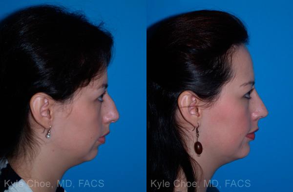  before and after photos in , , Chin Augmentation in Virginia Beach, VA