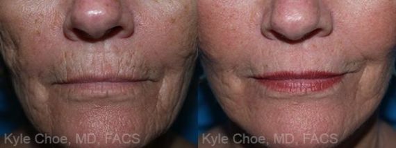  before and after photos in , , Microdermabrasion in Virginia Beach, VA