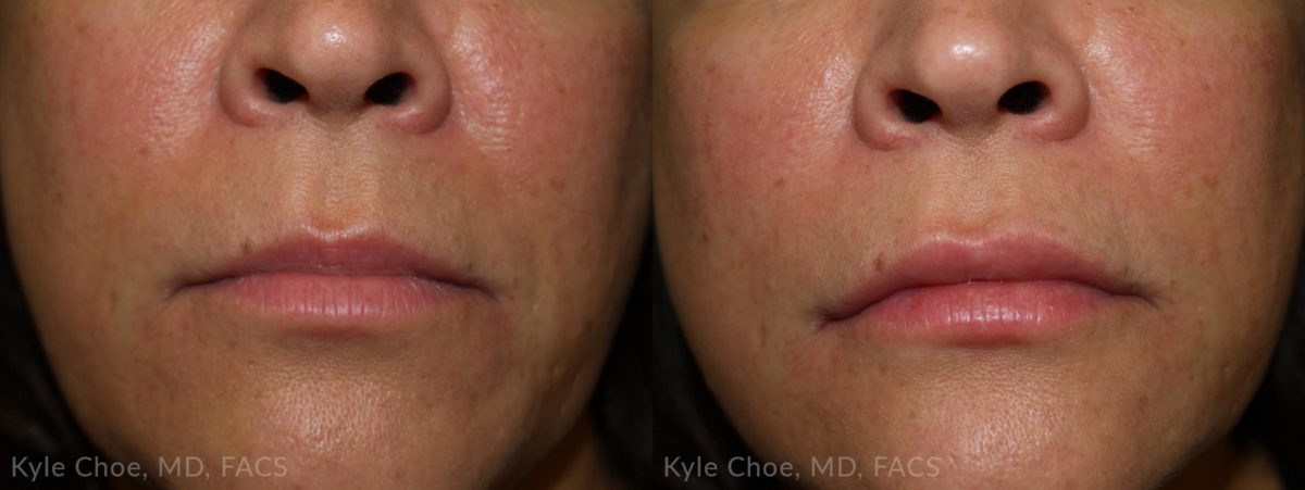  before and after photos in , , Juvederm Volbella® in Virginia Beach, VA