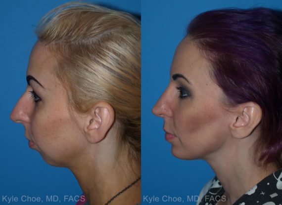  before and after photos in , , Rhinoplasty in Virginia Beach, VA