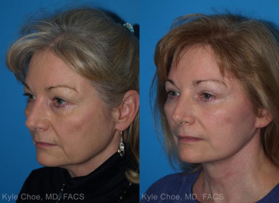  before and after photos in , , Neck Liposuction in Virginia Beach, VA