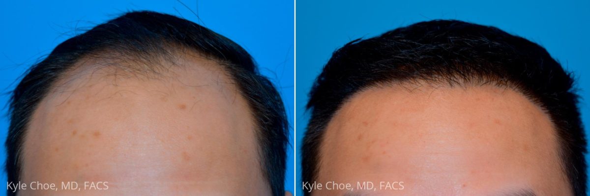  before and after photos in , , Hair Restoration in Virginia Beach, VA