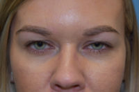 Blepharoplasty (Eyelid Surgery)