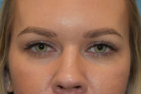 Blepharoplasty (Eyelid Surgery)