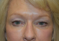 Blepharoplasty (Eyelid Surgery)