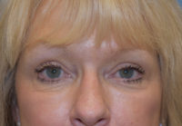 Blepharoplasty (Eyelid Surgery)