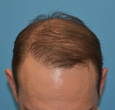 Hair Restoration