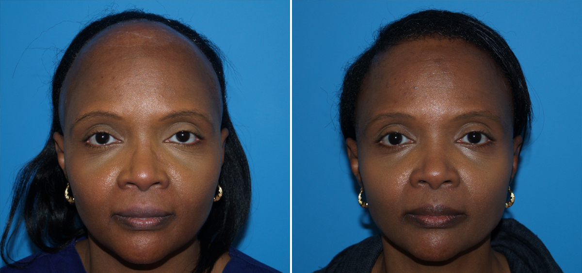 African-American Hair Restoration Virginia Beach | Hair Transplant Norfolk