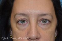 Blepharoplasty (Eyelid Surgery)