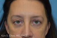 Blepharoplasty (Eyelid Surgery)