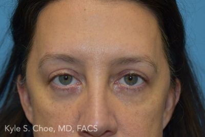 Blepharoplasty (Eyelid Surgery)