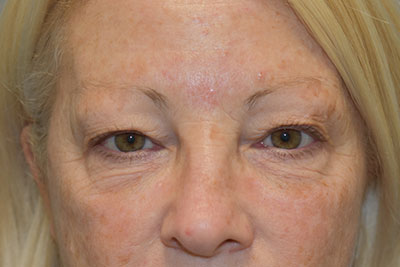 Blepharoplasty (Eyelid Surgery)