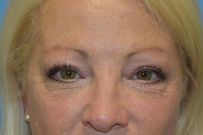 Blepharoplasty (Eyelid Surgery)