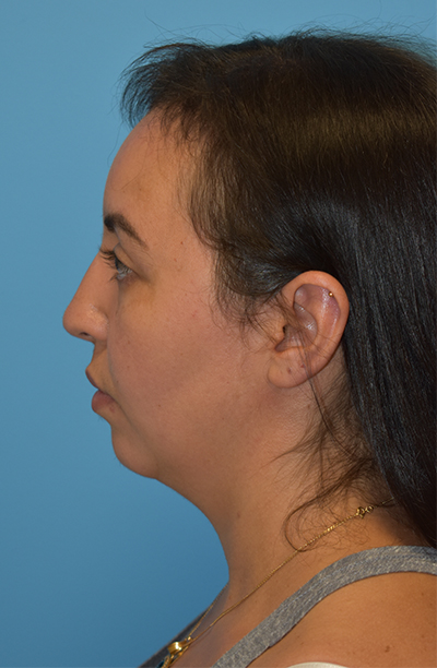 Chin Augmentation