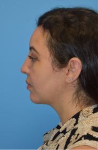 Chin Augmentation