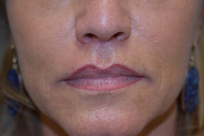 Lip Lift