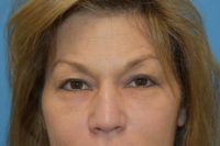 Blepharoplasty (Eyelid Surgery)