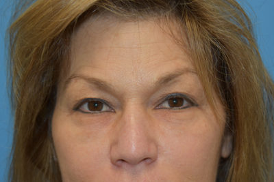 Blepharoplasty (Eyelid Surgery)