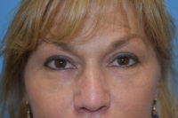 Blepharoplasty (Eyelid Surgery)