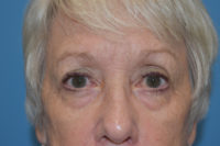 Blepharoplasty (Eyelid Surgery)