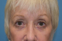 Blepharoplasty (Eyelid Surgery)