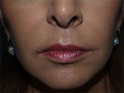 Lip Lift