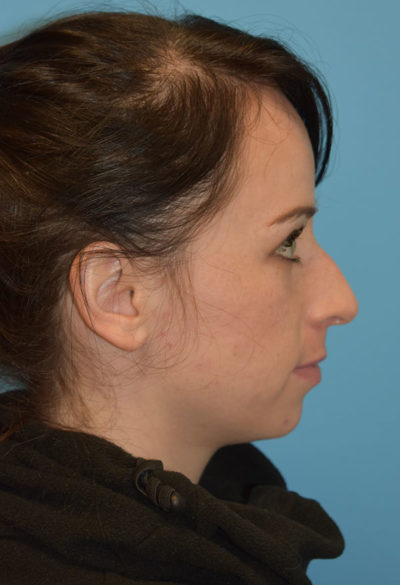 Chin Augmentation