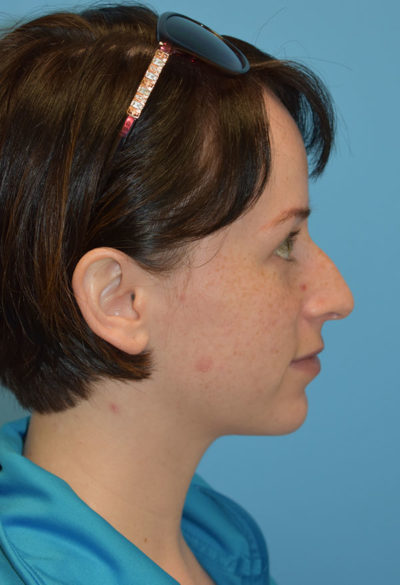 Chin Augmentation