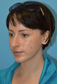 Chin Augmentation