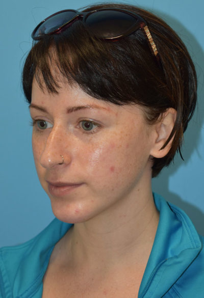 Chin Augmentation