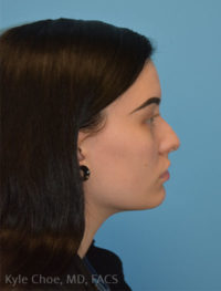 Rhinoplasty