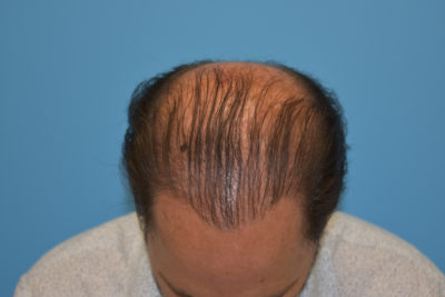 Hair Restoration