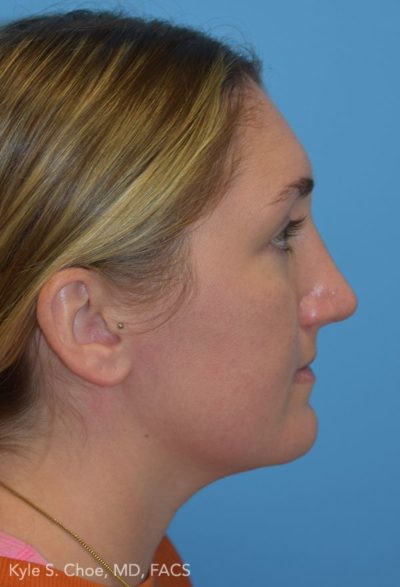 Rhinoplasty