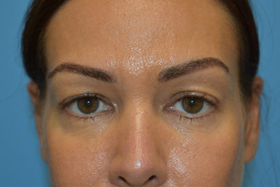 Blepharoplasty (Eyelid Surgery)