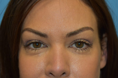 Blepharoplasty (Eyelid Surgery)