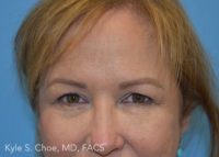 Blepharoplasty (Eyelid Surgery)