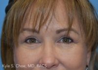 Blepharoplasty (Eyelid Surgery)