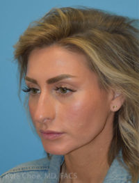 Rhinoplasty