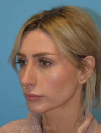 Rhinoplasty