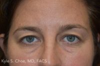 Blepharoplasty (Eyelid Surgery)