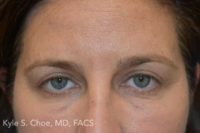 Blepharoplasty (Eyelid Surgery)