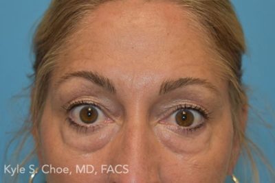 Blepharoplasty (Eyelid Surgery)