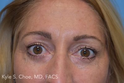 Blepharoplasty (Eyelid Surgery)