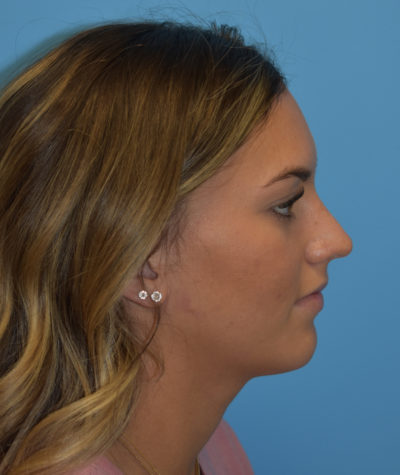 Rhinoplasty