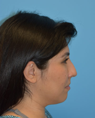 Rhinoplasty