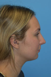 Rhinoplasty