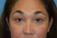 Blepharoplasty (Eyelid Surgery)